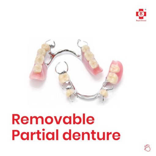Dental Implants vs Dentures
