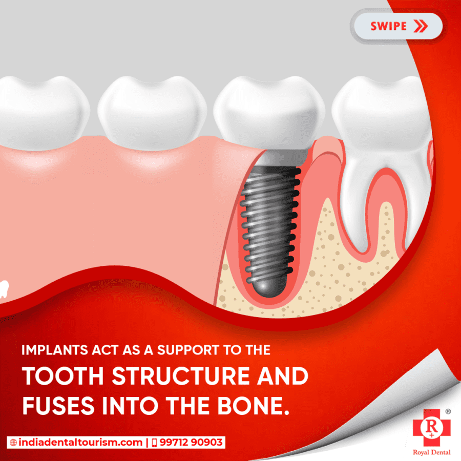 Dental-Implant