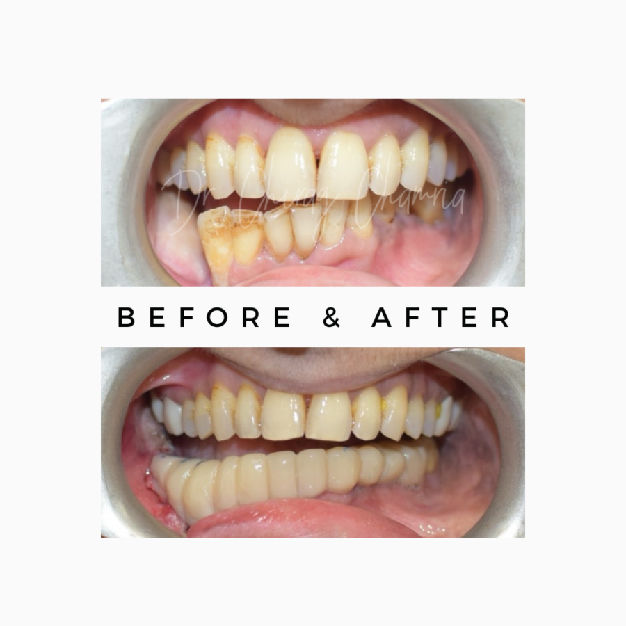 Cancer Rehabilitation with Fixed Teeth