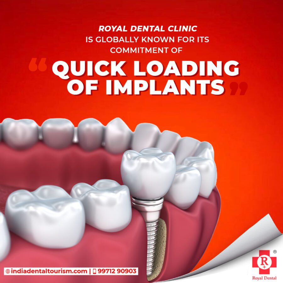teeth implants in mumbai