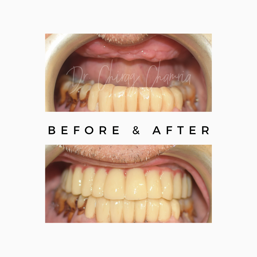 Teeth After Cancer Surgery in Mumbai