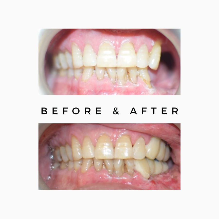 Oral Rehabilitation for Cancer Patients