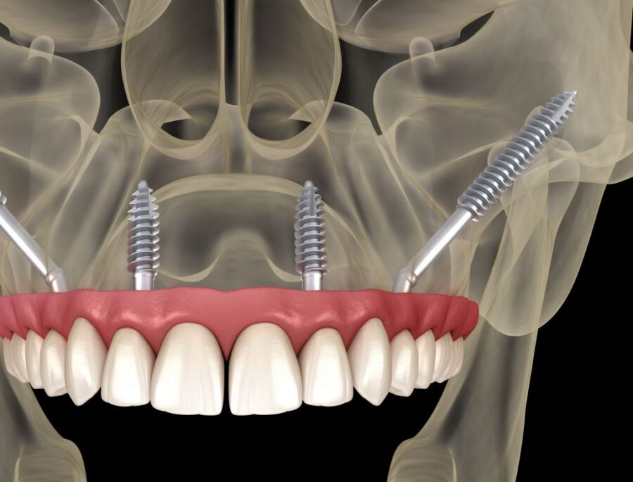 zygomatic implants