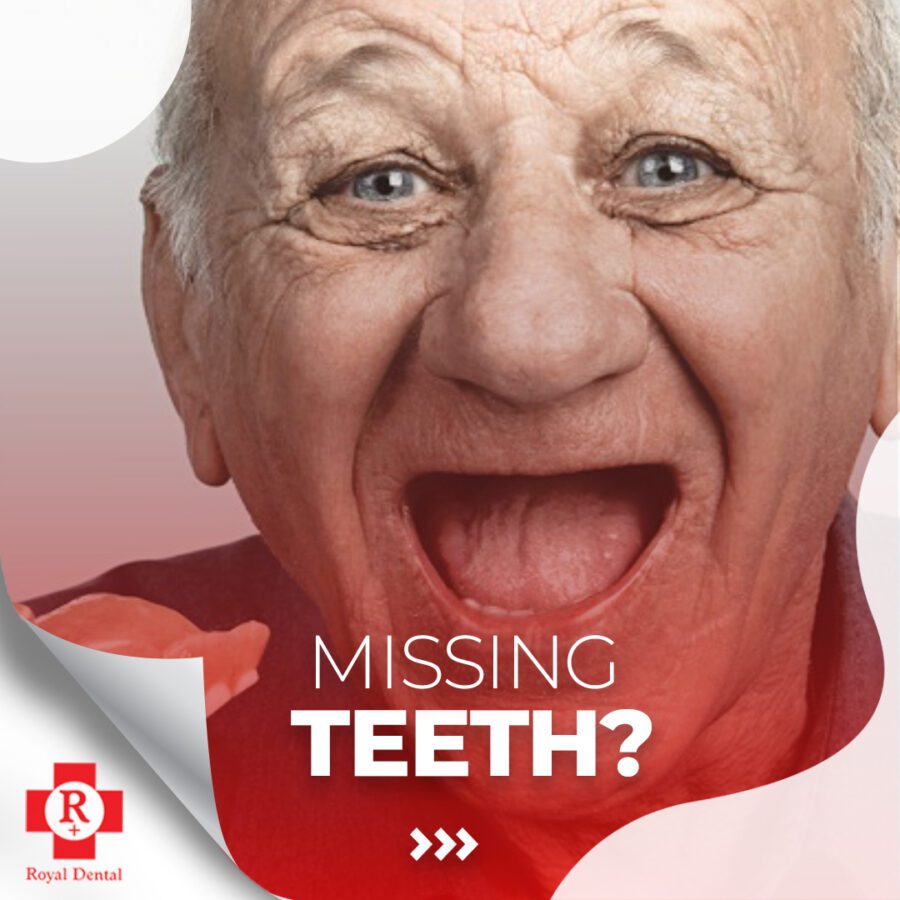 zygomatic-dental-implants