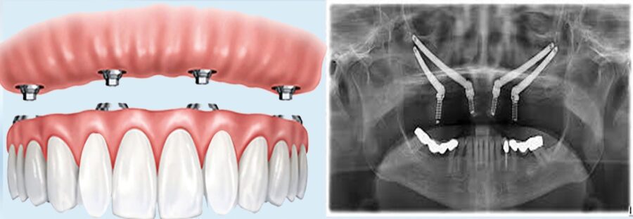 zygomatic implant vs dentures - Fixed Teeth in One Day