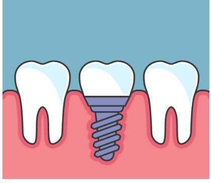 dental implant