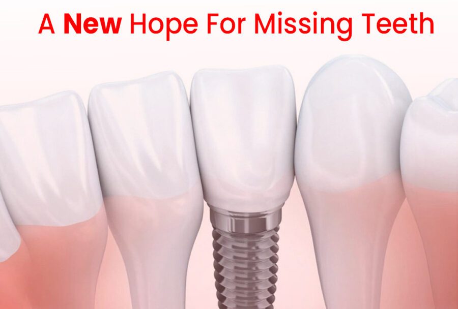 upper missing teeth