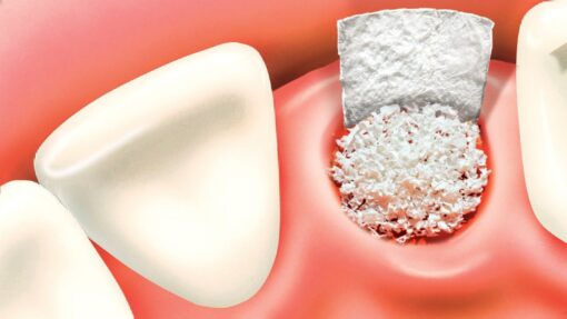 Bone grafts