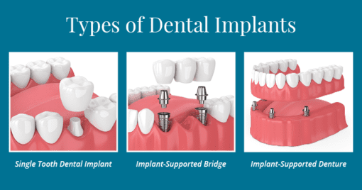 Dental Implants vs Bridges vs Dentures - Types of Dental Implants