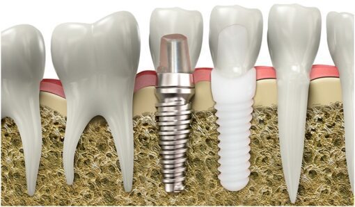 zirconia dental implants