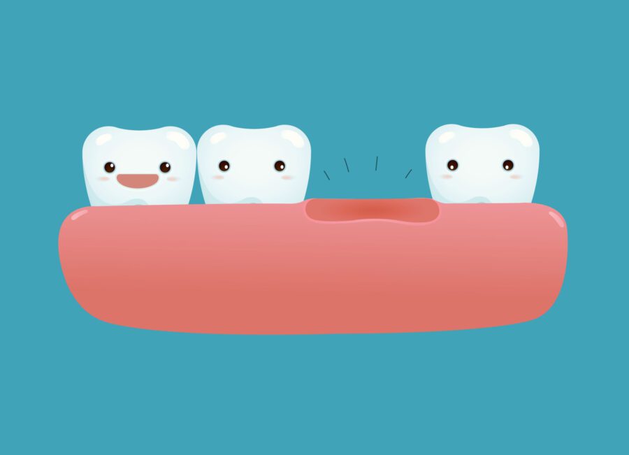 missing tooth implant
