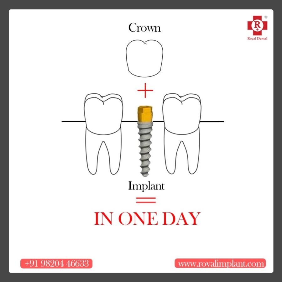 One day dental implant - Guide to Dental Implants