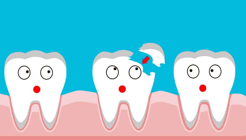 dental filling