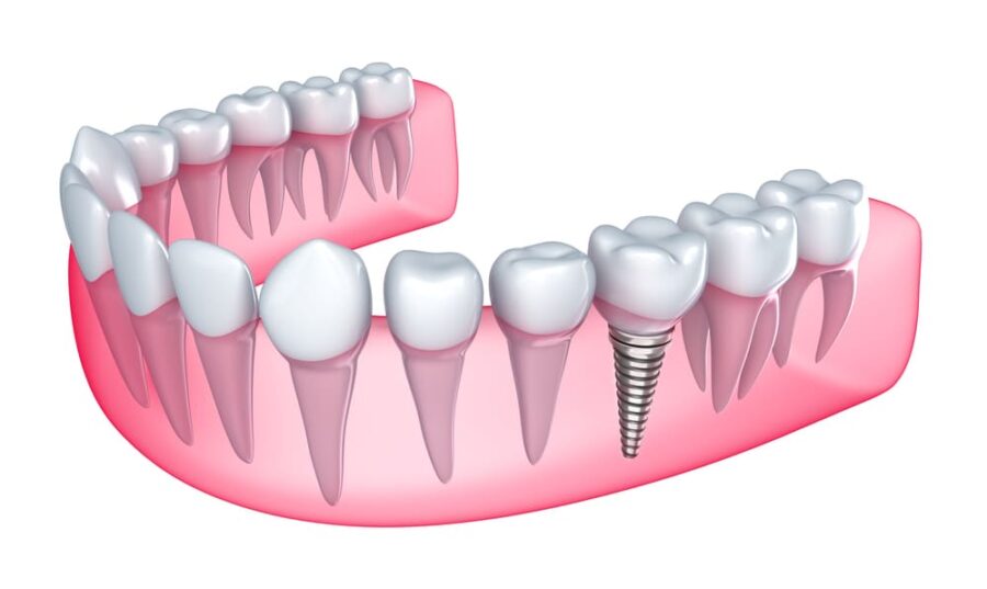 implant in bone