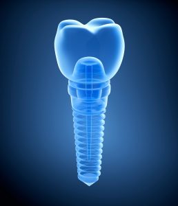 Digital Dental Implant