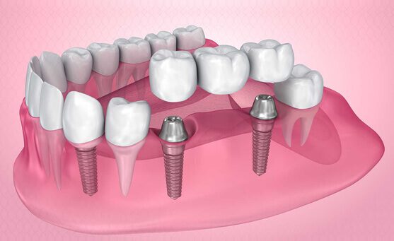 teeth implants bridge