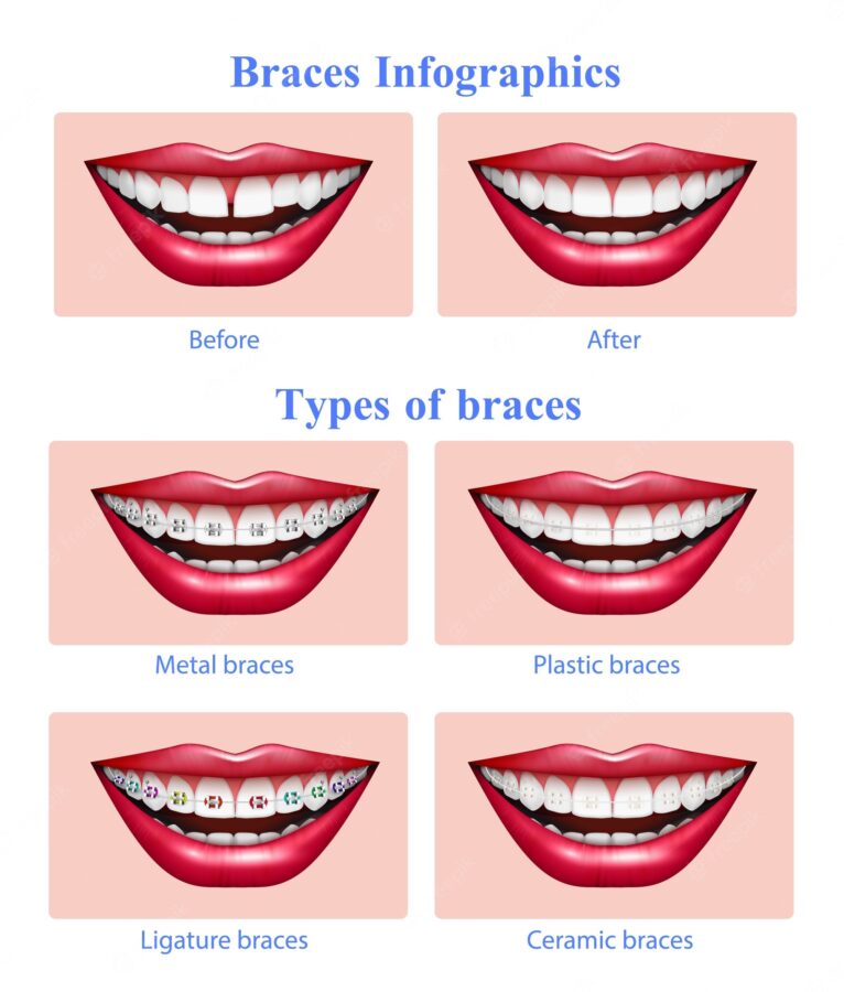 Braces Types