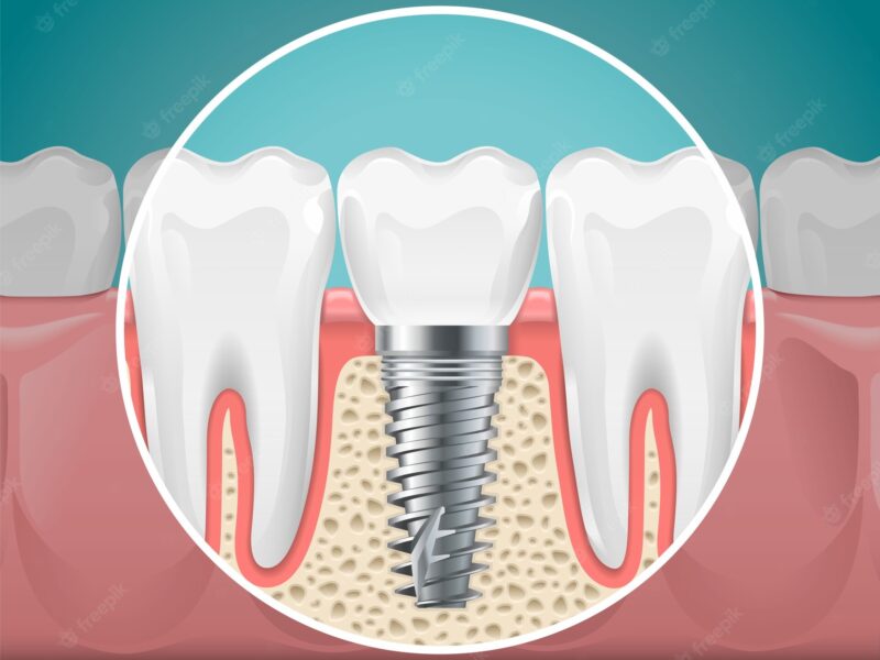 implant dentistry