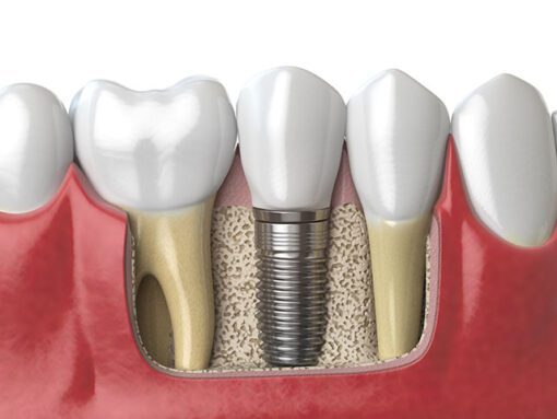 Single Implant in Bone