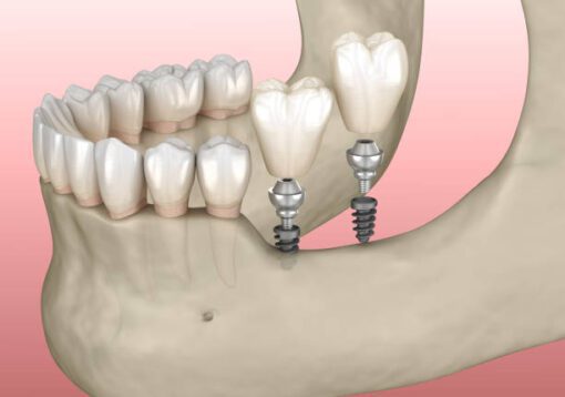 implant surgery in one day