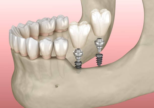 implant surgery in one day