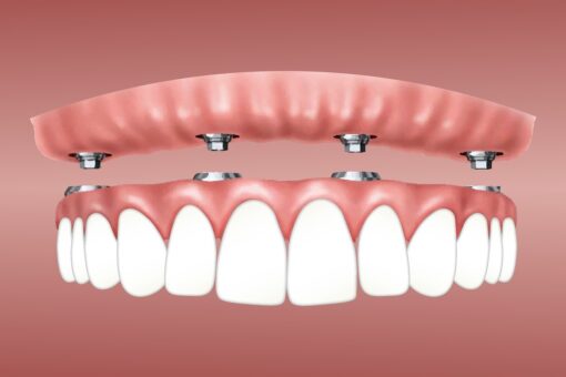 Implant Supported Dentures