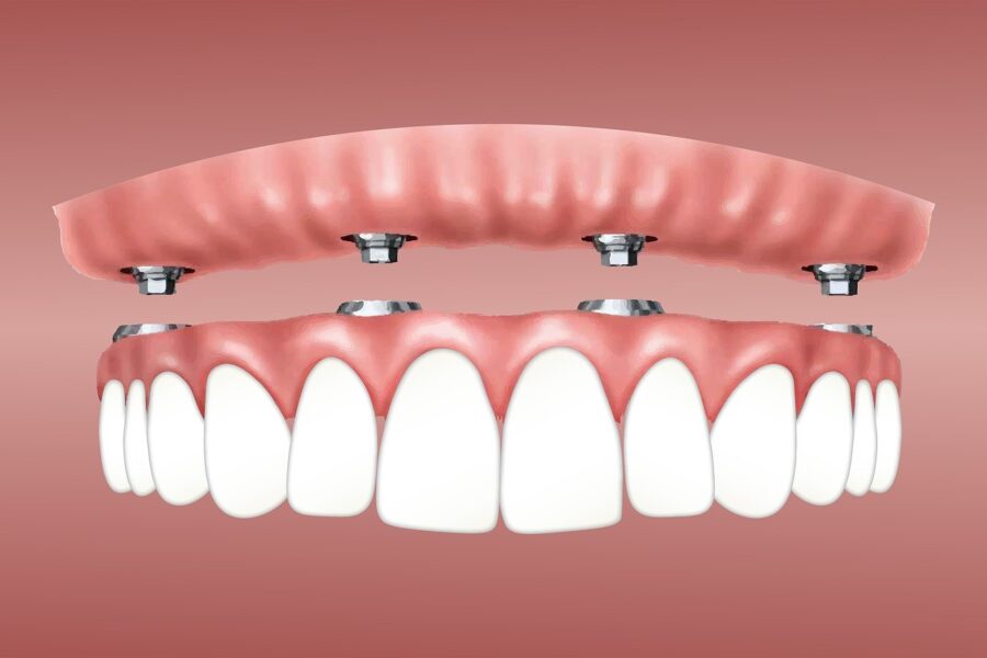Implant Supported Dentures