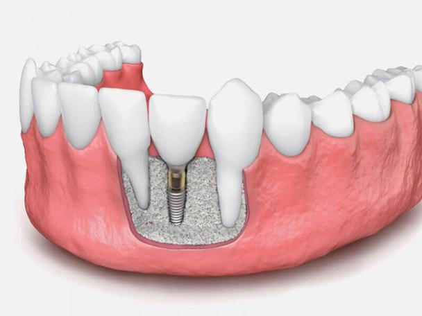 dental implants in one day