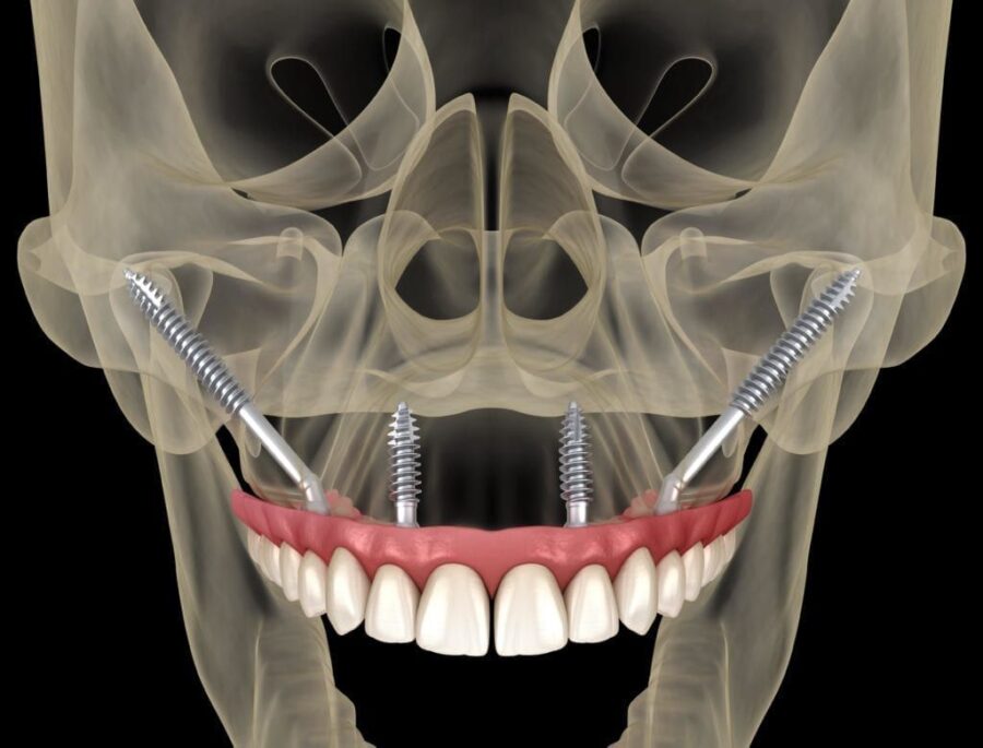 zygomatic implant in one day