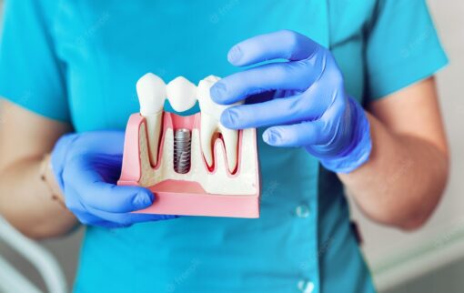 dental implants in chennai