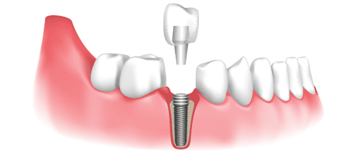 Dental crown with implant