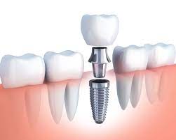 replacing single missing tooth