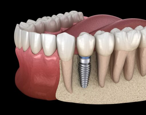 teeth implant