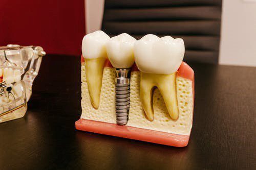 single dental implant