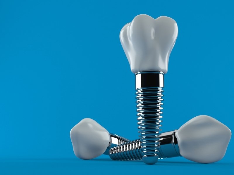 dental implant mumbai