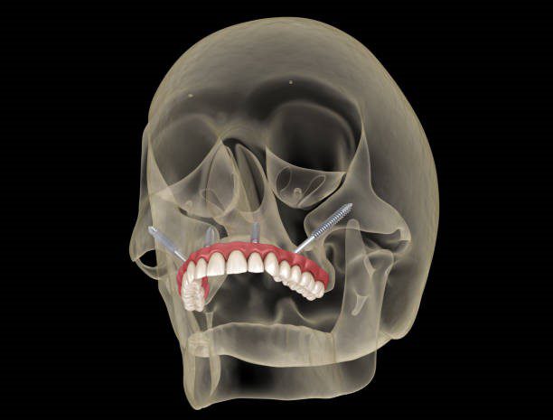 zygomatic dental implants