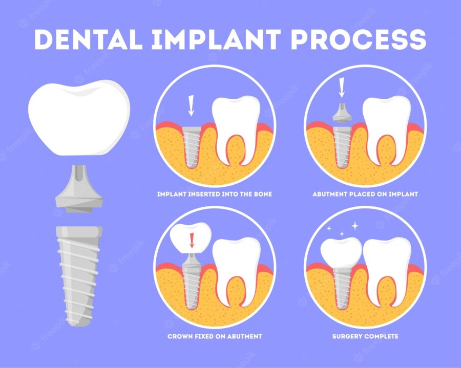 Dental Implant Procedure Protocol