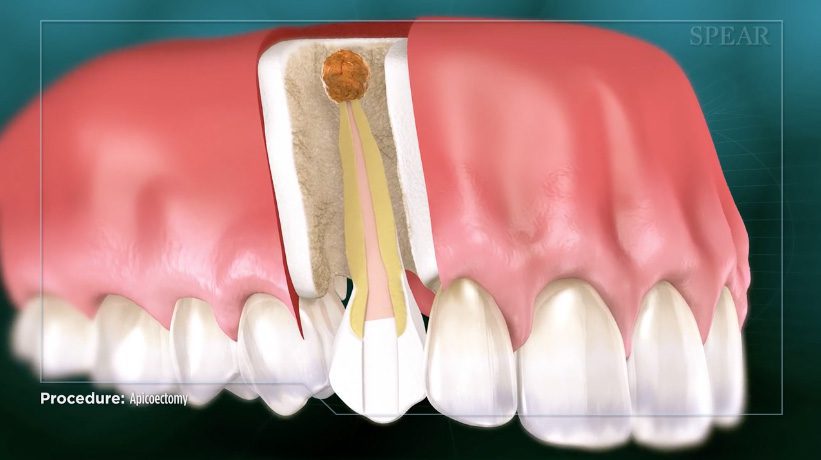 Apicoectomy-root-end-infections