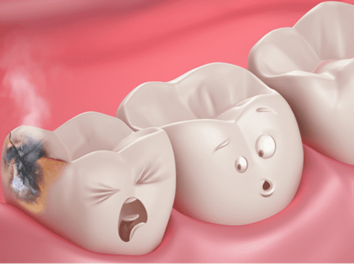 tooth decay cavities