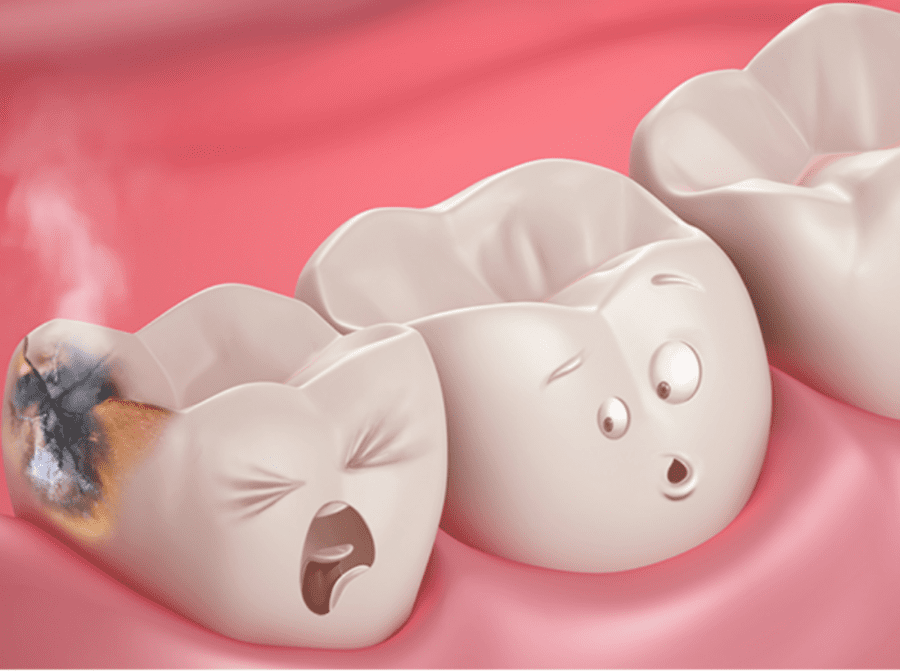 tooth decay cavities
