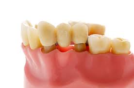 dental implants vs bridge