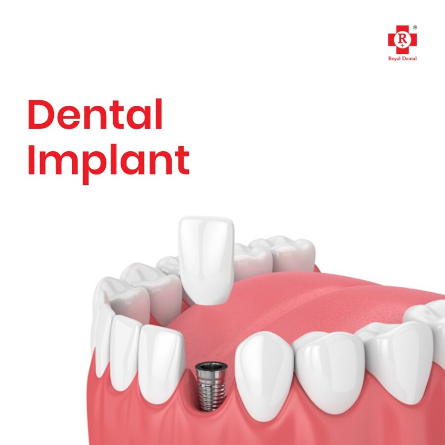 dental implant procedure