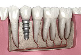 SAPTeeth