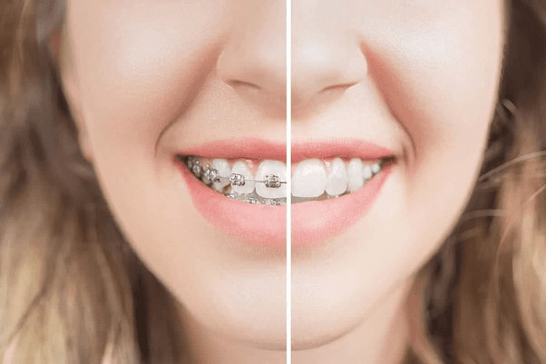 braces vs veneers - do braces change face shape