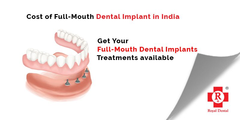 Teeth implants