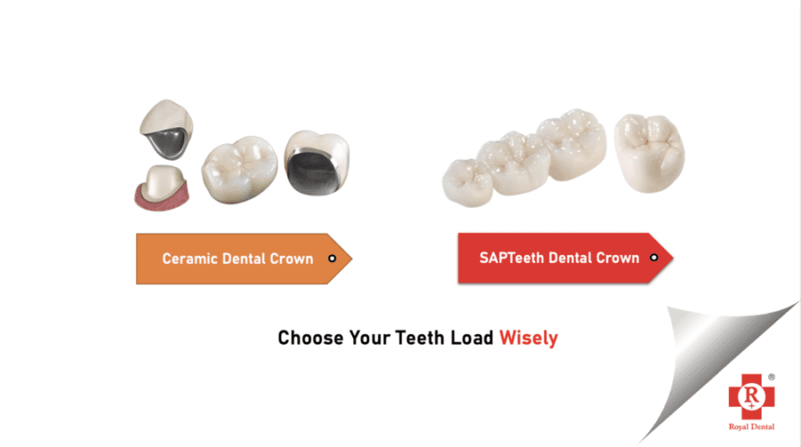 SAPTeeth vs Ceramic Crown
