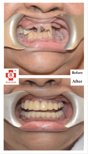 Before After Implants