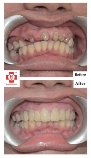 SAPTeeth Smile