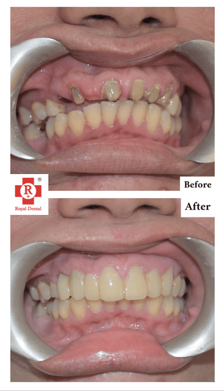 SAPTeeth Smile over Natural teeth