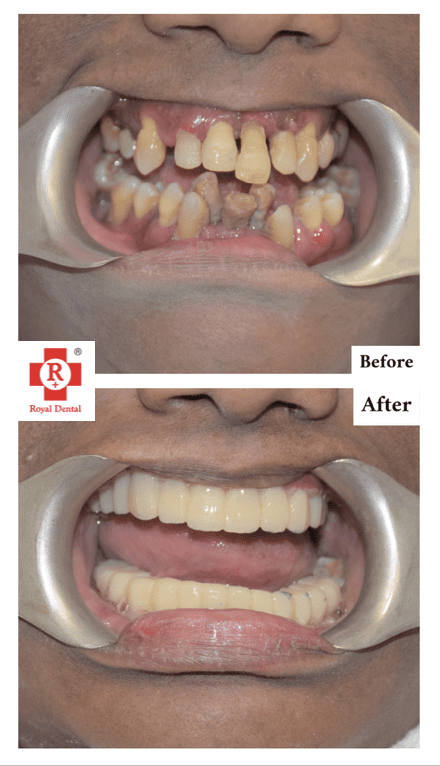 oral-cancer-oral-surgery